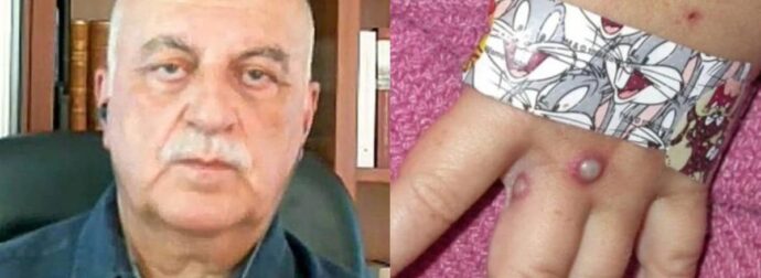 Ευλογιά των πιθήκων – Τζανάκης: Πpοσοχή στα χέρια, τα ρούχα και καλό ψήσιμο στο κρέας που τρώμε