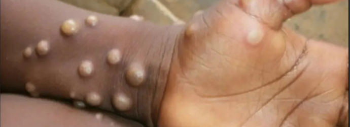 Ευλογια των πιθηκων: Εξαπλώνονται ραγδαία τα κρούσματα. Συμπτώματα, πώς μεταδίδεται, θεραπεία