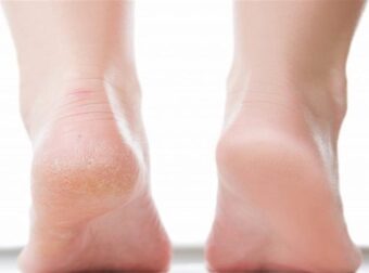 Σκασμένες φτέρνες: 2 φυσικές συνταγές για να τις ενυδατώσεις