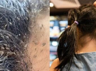 Μαρτυρικός Θάνατος Για 9χρονη: Η Μάνα Και Η Γιαγιά Της Την Άφησαν Να Πεθάνει Από Ψείρες