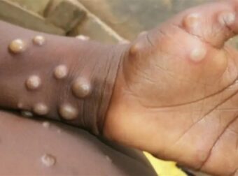 Ιταλία: Το πρώτο κρούσμα ευλογιάς των πιθήκων καταγράφηκε στη χώρα