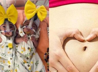 Γυναίκα Γέννησε Τις Δίδυμες Κορούλες Της Με 3 Μέρες Διαφορά!