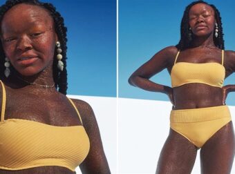 Jeyza Gary: Η σπάνια δερματική πάθηση που έχει δεν την εμπόδισε να γίνει μοντέλο [ΦΩΤΟ]