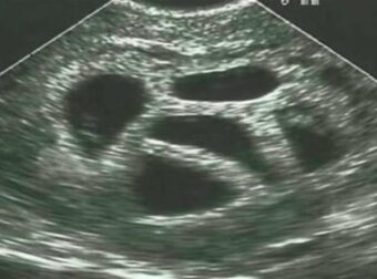 Μια έγκυος γυναίκα αγνόησε τις συμβουλές του γιατρού να κάνει έκτρωση… 20 χρόνια αργότερα δημοσιεύει αυτό!