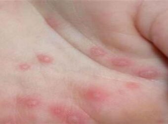 Προσοχή: Τι είναι ο ιός κοξάκι και πώς θα προστατεύσετε το παιδί σας από αυτό