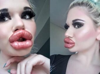 22χρονη εθισμένη στις πλαστικές, φούσκωσε τα χείλη της και πιστεύει ότι είναι κουκλάρα