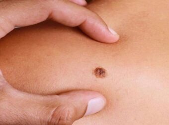 Καρκίνος του δέρματος: Ποια άτομα με αυτό το χαρακτηριστικό διατρέχουν μεγαλύτερο κίνδυνο