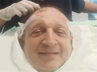 Αγνώριστος ο Σπύρος Μπιμπίλας: Δείτε τον με πυκνή κόμη μετά τη μεταμόσχευση μαλλιών [φωτο]