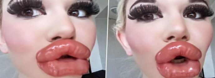 23χρονη πλήρωσε για τα μεγαλύτερα χείλη του κόσμου και οι άντρες θέλουν να την παντρευτούν