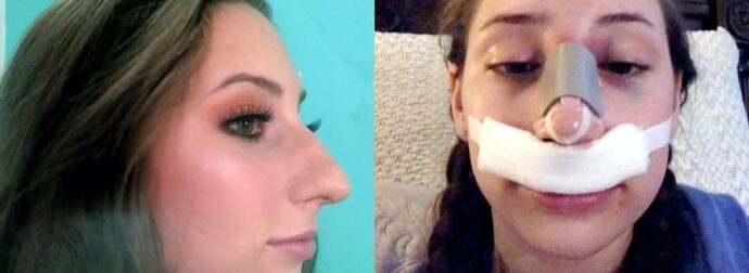 Γεννήθηκε με μεγάλη μύτη, την φώναζαν τέρας και ράμφος αλλά έκανε εγχείρηση και έγινε πιο όμορφη από μοντέλο