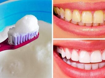 Οι 10 καλύτεροι τρόποι να λευκάνετε τα δόντια σας με φυσικό τρόπο στο σπίτι
