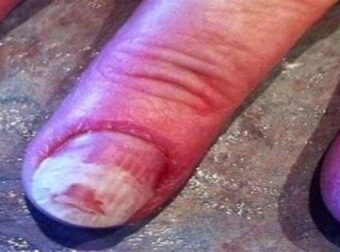 Κατέστρεψε τα νύχια της με ένα υλικό που όλες οι γυναίκες χρησιμοποιούν και είναι στο ημιμόνιμο!